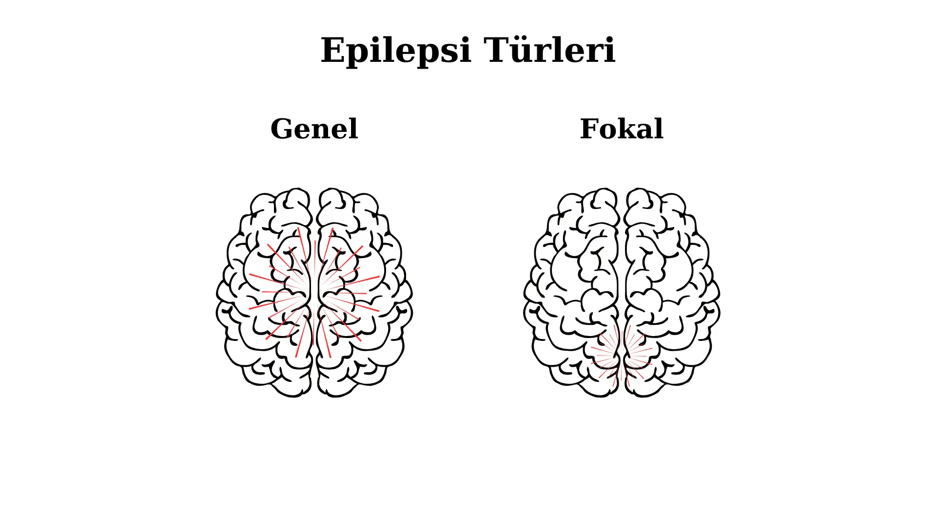 أنواع الصرع