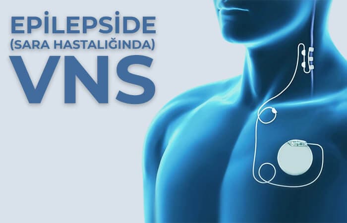Epilepsi Nedir?