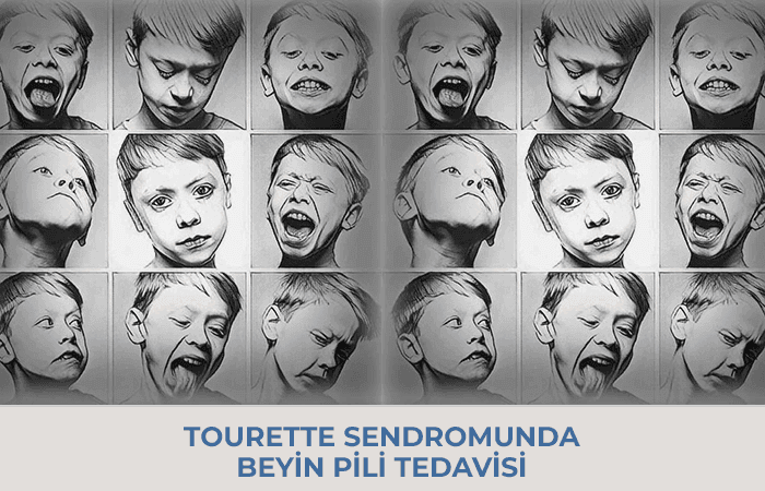 Tourette Sendromunda Beyin Pili Tedavisi