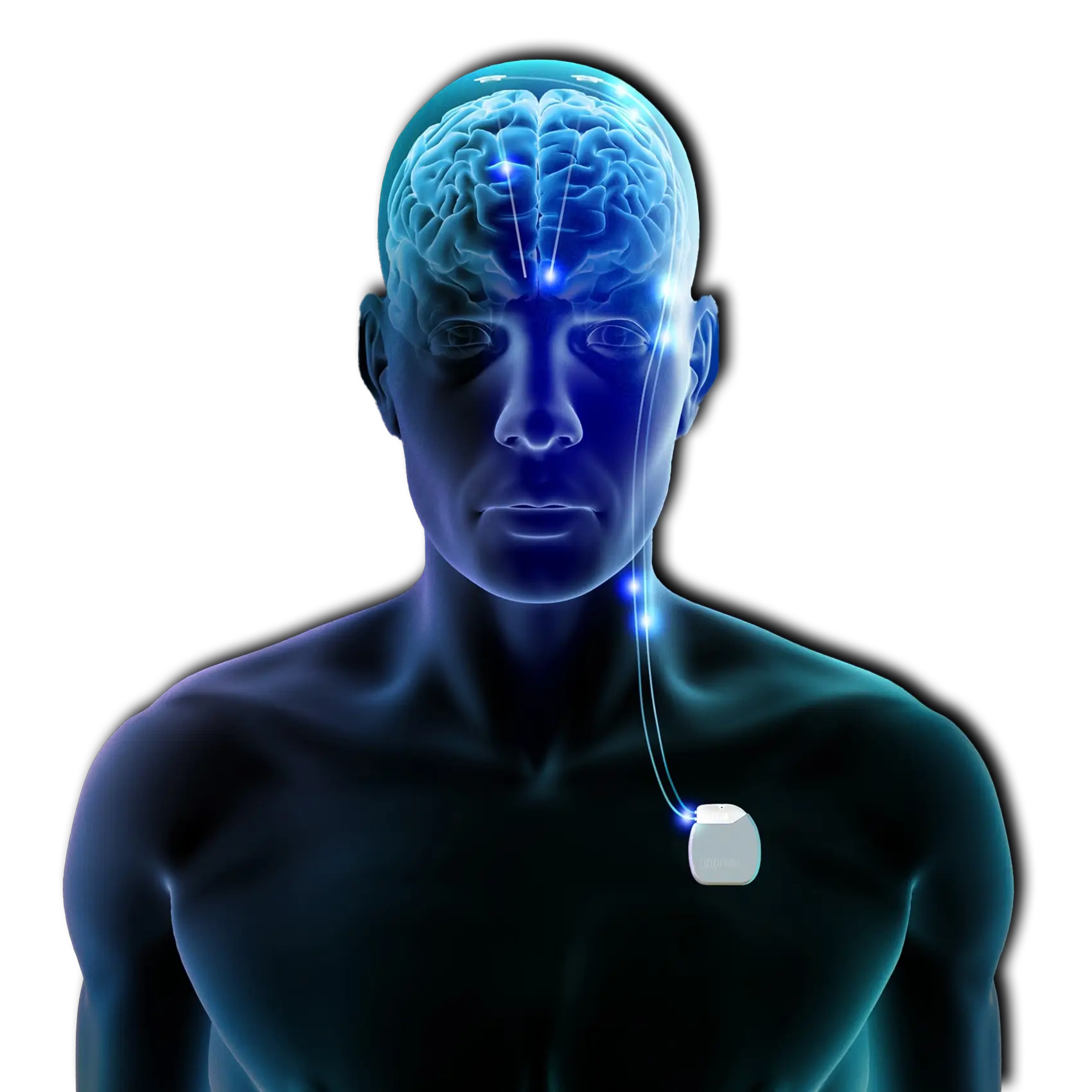 Derin beyin stimülasyonu görselleştirmesi